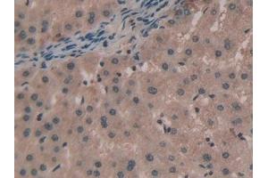 Detection of TNPO1 in Human Liver cancer Tissue using Polyclonal Antibody to Transportin 1 (TNPO1)