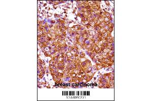 IRX3 Antibody immunohistochemistry analysis in formalin fixed and paraffin embedded human breast carcinoma followed by peroxidase conjugation of the secondary antibody and DAB staining.