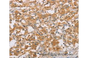 Immunohistochemistry of Human thyroid cancer using ARHGEF7 Polyclonal Antibody at dilution of 1:40