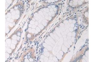 Detection of F8 in Human Colorectal cancer Tissue using Polyclonal Antibody to Coagulation Factor VIII (F8)