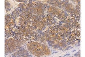 ABIN6259932 and ABIN6277014 at 1/100 staining human small cell lung carcinoma by IHC-P. (ANGPTL4 anticorps  (N-Term))