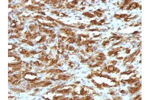 Formalin-fixed, paraffin-embedded human Rhabdomyosarcoma stained with Muscle Specific Actin Mouse Monoclonal Antibody (HHF35). (ACTA1/ACTA2A/ACTG2 anticorps)