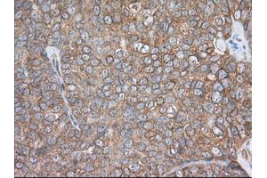 Immunohistochemical staining of paraffin-embedded Adenocarcinoma of Human colon tissue using anti-PDE4A mouse monoclonal antibody. (PDE4A anticorps)