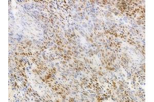 ABIN6263144 and ABIN6277139 at 1/100 staining human large cell lung carcinoma by IHC-P. (MAX anticorps  (N-Term))