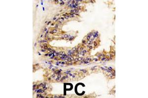 Formalin-fixed and paraffin-embedded human prostate carcinoma reacted with BRAF polyclonal antibody  , which was peroxidase-conjugated to the secondary antibody, followed by DAB staining. (BRAF anticorps  (Internal Region))