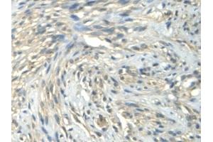 Detection of CALML3 in Human Uterine fibroids Tissue using Polyclonal Antibody to Calmodulin Like Protein 3 (CALML3) (CALML3 anticorps  (AA 1-149))