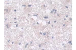 Detection of MOSC1 in Human Glioma Tissue using Polyclonal Antibody to MOCO Sulphurase C-Terminal Domain Containing Protein 1 (MOSC1) (MOSC1 anticorps  (AA 41-335))