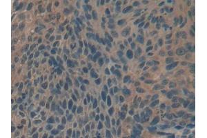 DAB staining on IHC-P; Samples: Human Esophagus cancer Tissue (Biglycan anticorps  (AA 243-369))