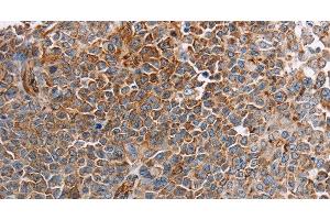 Immunohistochemistry of paraffin-embedded Human ovarian cancer tissue using PLXNA2 Polyclonal Antibody at dilution 1:40 (Plexin A2 anticorps)