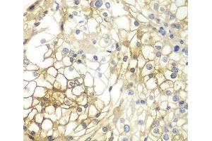 Immunohistochemistry of paraffin-embedded Human kidney cancer using Syndecan-1 Polyclonal Antibody at dilution of 1:200 (40x lens). (Syndecan 1 anticorps)