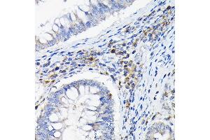 Immunohistochemistry of paraffin-embedded human colon carcinoma using LILRB4 Rabbit pAb (ABIN6131872, ABIN6143221, ABIN6143222 and ABIN6222869) at dilution of 1:100 (40x lens).