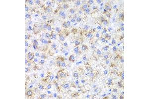 Immunohistochemistry of paraffin-embedded human liver cancer using HAO1 antibody. (HAO1 anticorps)