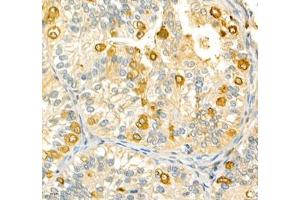 Immunohistochemistry of paraffin embedded human metrocarcinoma using ANXA3 (ABIN7073065) at dilution of 1: 200 (400x lens)