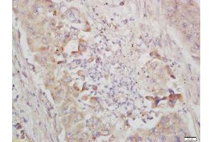 Formalin-fixed and paraffin embedded human lung carcinoma labeled with Rabbit Anti-IKB epsilon Polyclonal Antibody, Unconjugated  at 1:200 followed by conjugation to the secondary antibody and DAB staining