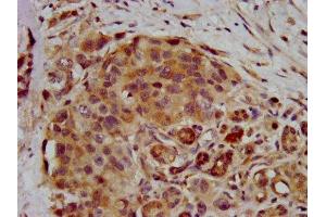 IHC image of ABIN7168260 diluted at 1:400 and staining in paraffin-embedded human pancreatic cancer performed on a Leica BondTM system. (RNF39 anticorps  (AA 200-321))