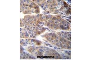 PLA2G2C Antibody (C-term) (ABIN655935 and ABIN2845327) immunohistochemistry analysis in formalin fixed and paraffin embedded human melanoma followed by peroxidase conjugation of the secondary antibody and DAB staining.