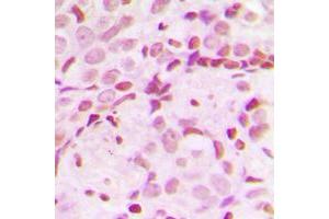Immunohistochemical analysis of TCOF1 staining in human breast cancer formalin fixed paraffin embedded tissue section.