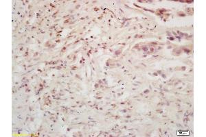 Formalin-fixed and paraffin embedded human colon carcinoma labeled with Rabbit Anti BMI1/PCGF4 Polyclonal Antibody, Unconjugated (ABIN682678) at 1:200 followed by conjugation to the secondary antibody and DAB staining (BMI1 anticorps  (AA 61-160))