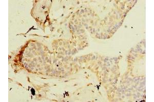 Immunohistochemistry of paraffin-embedded human breast cancer using ABIN7171449 at dilution of 1:100 (TCP11L2 anticorps  (AA 1-210))