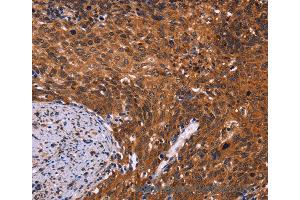 Immunohistochemistry of Human colon cancer using CDC5L Polyclonal Antibody at dilution of 1:40 (CDC5L anticorps)