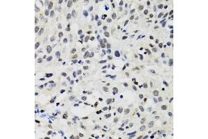 Immunohistochemistry of paraffin-embedded human lung cancer using SMARCAD1 antibody.