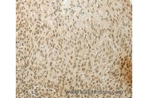 Immunohistochemistry of Human cervical cancer using MYSM1 Polyclonal Antibody at dilution of 1:60 (MYSM1 anticorps)