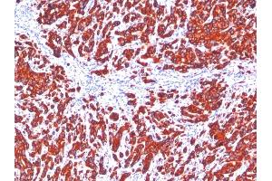 Formalin-fixed, paraffin-embedded human Breast Carcinoma stained with pan Cytokeratin Monoclonal Antibody cocktail (SPM115 + SPM116). (KRT77, KRT76 anticorps)