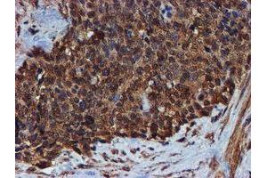 Immunohistochemical staining of paraffin-embedded Adenocarcinoma of Human breast tissue using anti-ENDOG mouse monoclonal antibody. (Endonuclease G anticorps)