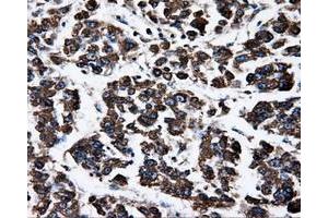 Immunohistochemical staining of paraffin-embedded Carcinoma of liver tissue using anti-ATP5Bmouse monoclonal antibody.