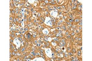Immunohistochemical analysis of paraffin-embedded Human esophagus cancer tissue using at dilution 1/20. (Adenosine A3 Receptor anticorps  (Internal Region))