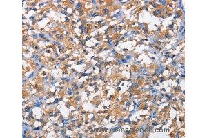 Immunohistochemistry of Human thyroid cancer using PFKP Polyclonal Antibody at dilution of 1:50 (PFKP anticorps)