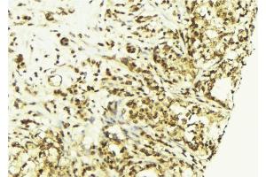 ABIN6269077 at 1/100 staining Human breast cancer tissue by IHC-P.