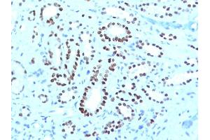 Formalin-fixed, paraffin-embedded human Renal Cell Carcinoma stained with PAX8 Monoclonal Antibody (PAX8/1491 + PAX8/1492). (PAX8 anticorps)