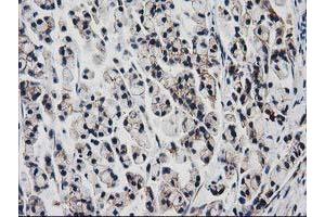 Immunohistochemical staining of paraffin-embedded Adenocarcinoma of Human colon tissue using anti-VCAM1 mouse monoclonal antibody. (VCAM1 anticorps)
