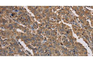 Immunohistochemistry of paraffin-embedded Human liver cancer tissue using KCNG1 Polyclonal Antibody at dilution 1:40