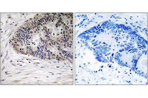 Immunohistochemical staining of paraffin-embedded human colon carcinoma tissue reacted with MDM4 (phospho S367) polyclonal antibody  at 1:50-1:100 dilution. (MDM4-binding Protein anticorps  (pSer367))