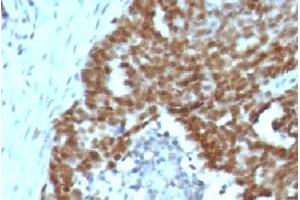 Formalin-fixed, paraffin-embedded human ovarian carcinoma stained with Nucleolin antibody.