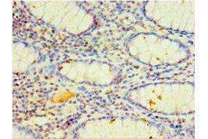 Immunohistochemistry of paraffin-embedded human colon cancer using ABIN7149272 at dilution of 1:100 (CYP4F12 anticorps  (AA 265-524))
