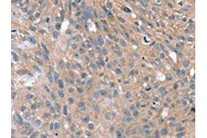 The image on the left is immunohistochemistry of paraffin-embedded Human breast cancer tissue using ABIN7192632(SPON1 Antibody) at dilution 1/25, on the right is treated with synthetic peptide.