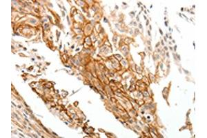 The image on the left is immunohistochemistry of paraffin-embedded Human cervical cancer tissue using ABIN7192777(TGM1 Antibody) at dilution 1/25, on the right is treated with synthetic peptide. (TGM1 anticorps)