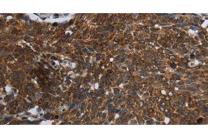 Immunohistochemistry of paraffin-embedded Human cervical cancer using FASTKD2 Polyclonal Antibody at dilution of 1:45 (FASTKD2 anticorps)