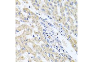 Immunohistochemistry of paraffin-embedded human liver injury using ITPKB antibody at dilution of 1:100 (x40 lens).