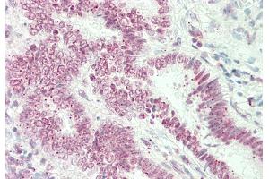 Rabbit Anti-ST6GALNAC1 antibody  Formalin Fixed Paraffin Embedded Tissue: Human Uterus Primary antibody Concentration: 1:100 Secondary Antibody: Donkey anti-Rabbit-Cy3 Secondary Antibody Concentration: 1:200 Magnification: 20x Exposure Time: 0.