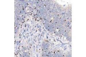 Immunohistochemistry of paraffin-embedded human colon carcinoma using IKZF3 antibody (ABIN7267842) at dilution of 1:100 (40x lens).