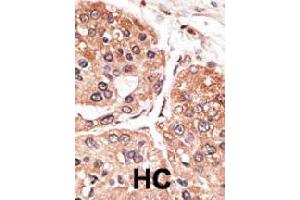 Formalin-fixed and paraffin-embedded human hepatocellular carcinoma tissue reacted with SMYD5 polyclonal antibody  , which was peroxidase-conjugated to the secondary antibody, followed by DAB staining. (SMYD5 anticorps  (C-Term))