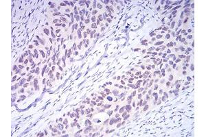 Immunohistochemical analysis of paraffin-embedded cervical cancer tissues using DNMT3A mouse mAb with DAB staining.