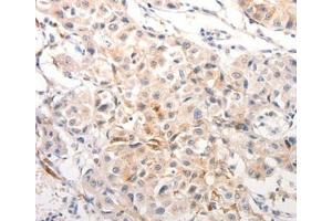 Immunohistochemical analysis of paraffin-embedded Human breast cancer tissue using. (Keratin 6B anticorps)