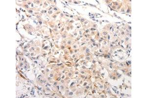 Immunohistochemical analysis of paraffin-embedded Human breast cancer tissue using. (Keratin 6B anticorps  (Internal Region))