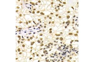 Immunohistochemistry of paraffin-embedded human kidney cancer using DDB1 Antibody. (DDB1 anticorps)
