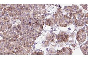 ABIN6273263 at 1/100 staining Human pancreas cancer tissue by IHC-P. (EIF2D anticorps  (Internal Region))